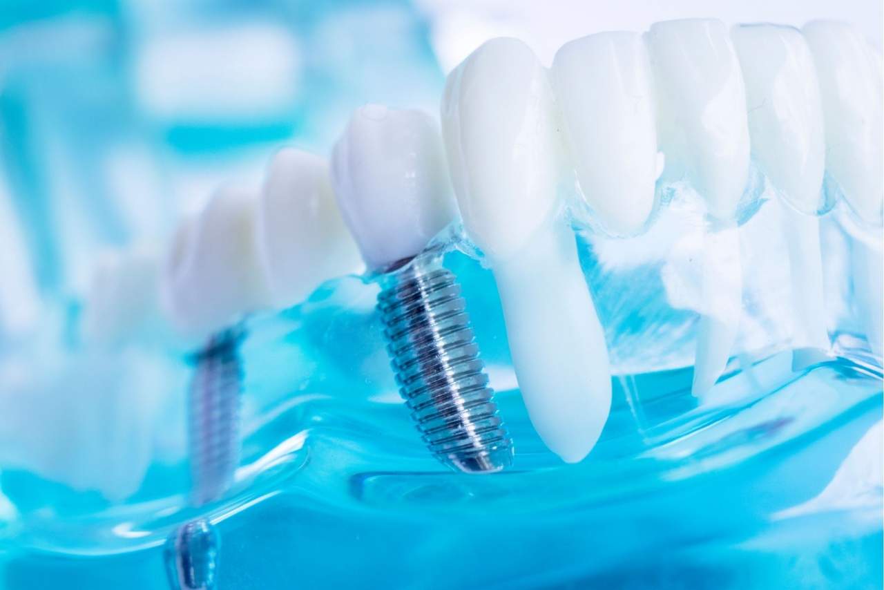 Dentix implante en Sevilla